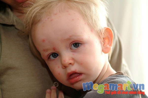 Trẻ bị phát ban sau khi hết sốt khoảng 2-3 ngày
