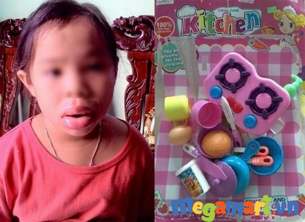Hình ảnh bé gái bị dị ứng môi khi chơi đồ chơi nấu ăn nhựa Trung Quốc