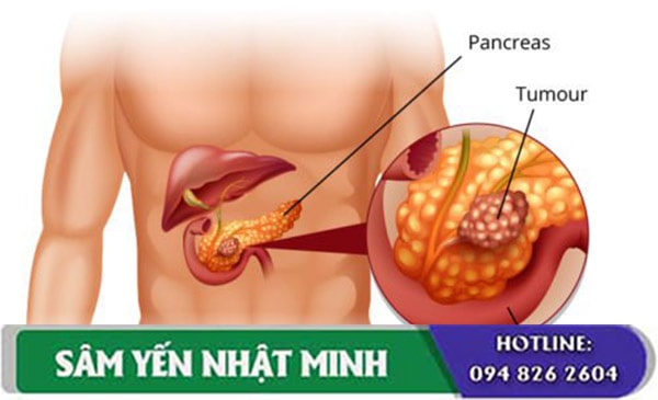 bệnh tiểu đường gây ra nguy hiểm cho sức khỏe