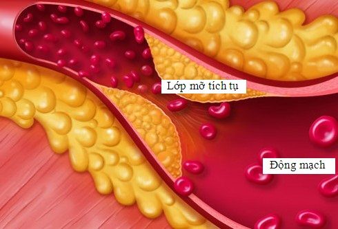 Dầu mỡ gây tắt nghẽn mạch máu