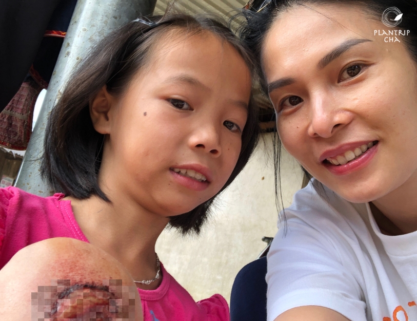 Bé gái bị thương ở chân và tôi.