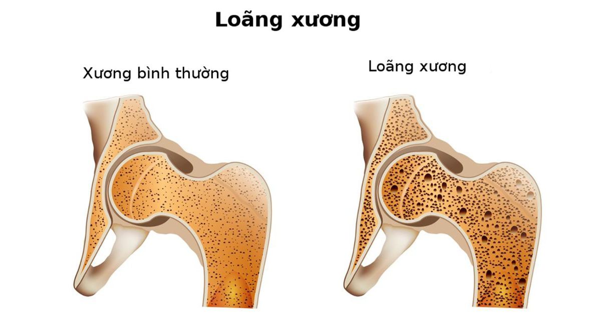 bệnh loãng xương ở người cao tuổi