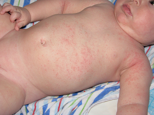trẻ bị rôm sẩy