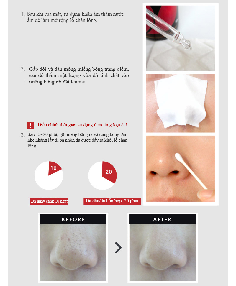 Mỹ phẩm queenie Tinh chất đặc trị mụn đầu đen