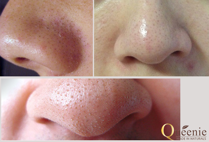 Mỹ phẩm queenie Tinh chất đặc trị mụn đầu đen