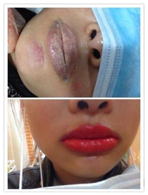 muc-xam-gia-gay-hau-qua-nghiem-trong