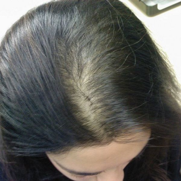 Hói ở mức trung bình, chủ yếu tập trung ở vùng trước trán và lan ra giữa đỉnh đầu