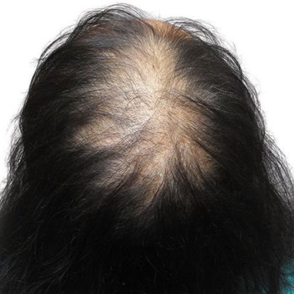 Dù không thể ngăn thời gian, nhưng hiểu rõ nguyên nhân giúp bạn chọn đúng giải pháp chăm sóc tóc - từ dinh dưỡng, sản phẩm đặc trị đến can thiệp thẩm mỹ (nếu cần)