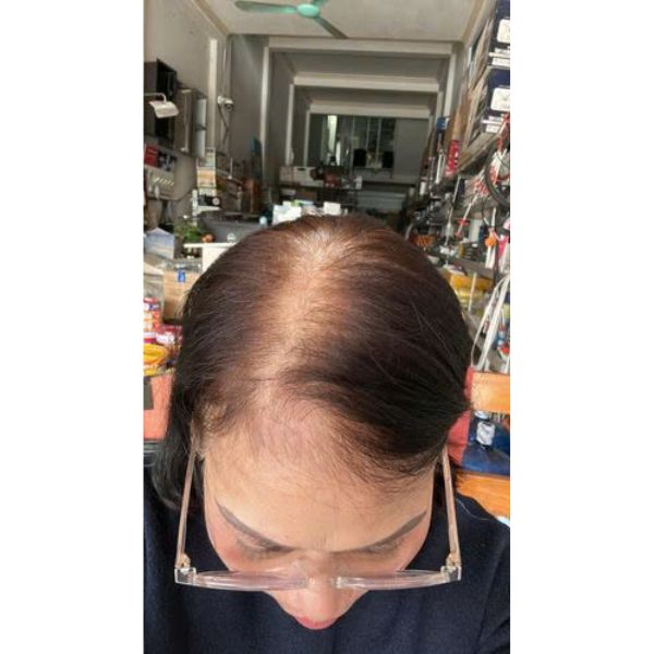 Hói nhiều hoặc hói lan rộng ở toàn bộ đỉnh đầu và trán