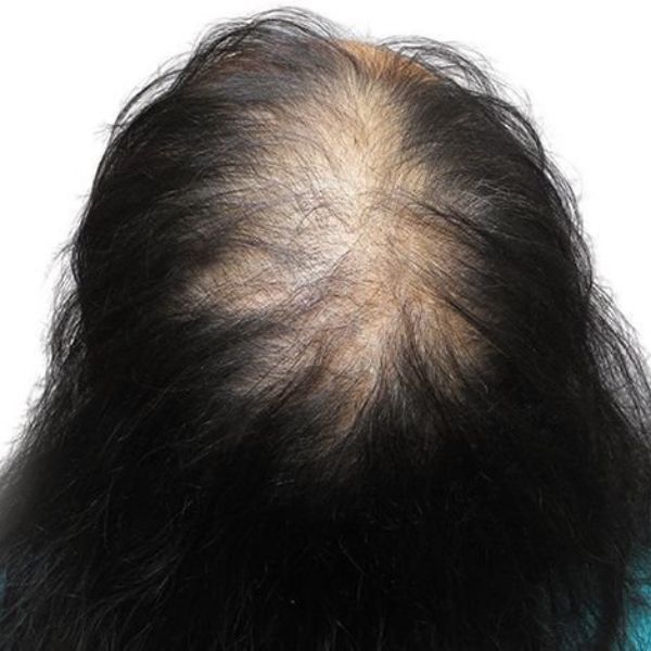 Hói rất nhiều hoặc toàn bộ vùng đỉnh đầu và trước trán đều không còn tóc