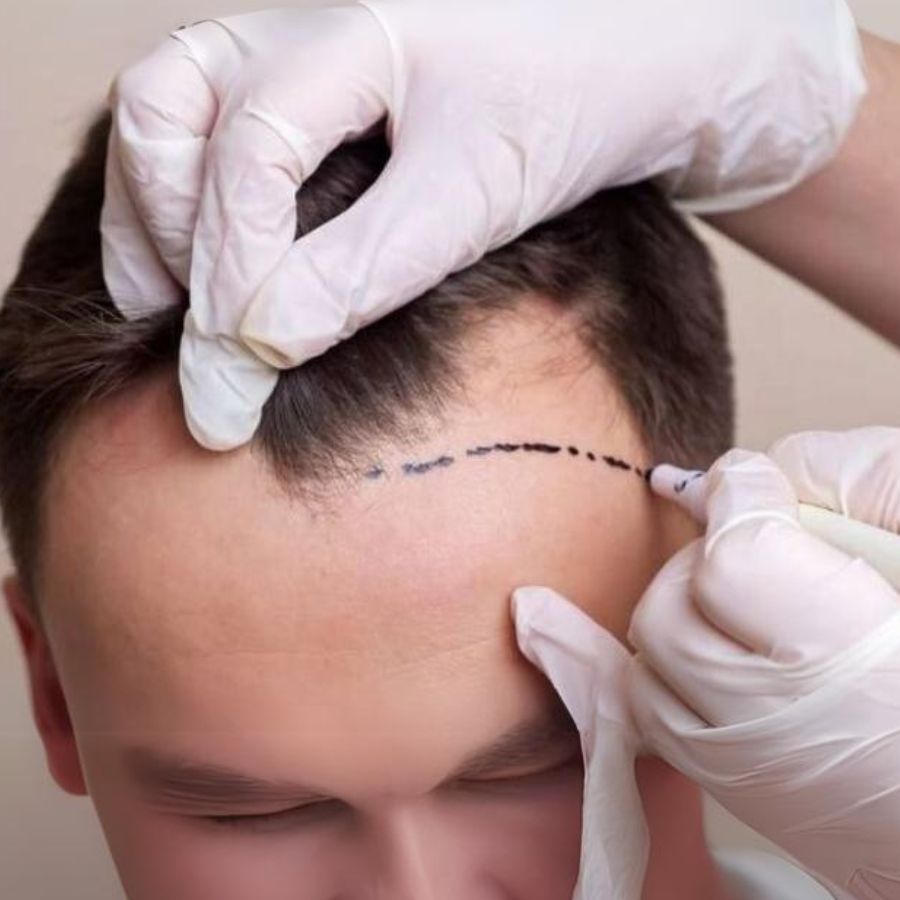 Biện pháp cấy tóc