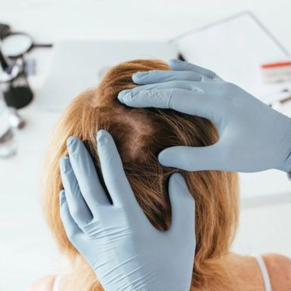 Nếu bạn đang thắc mắc tóc rụng nhiều có sao không, câu trả lời là có