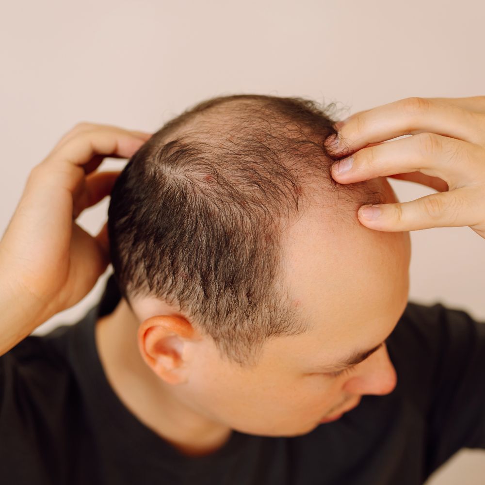 Hiểu đúng về cấu trúc nang tóc thay đổi như thế nào khi già đi chính là chìa khóa để tìm ra giải pháp che hói đầu tuổi trung niên thực sự bền vững