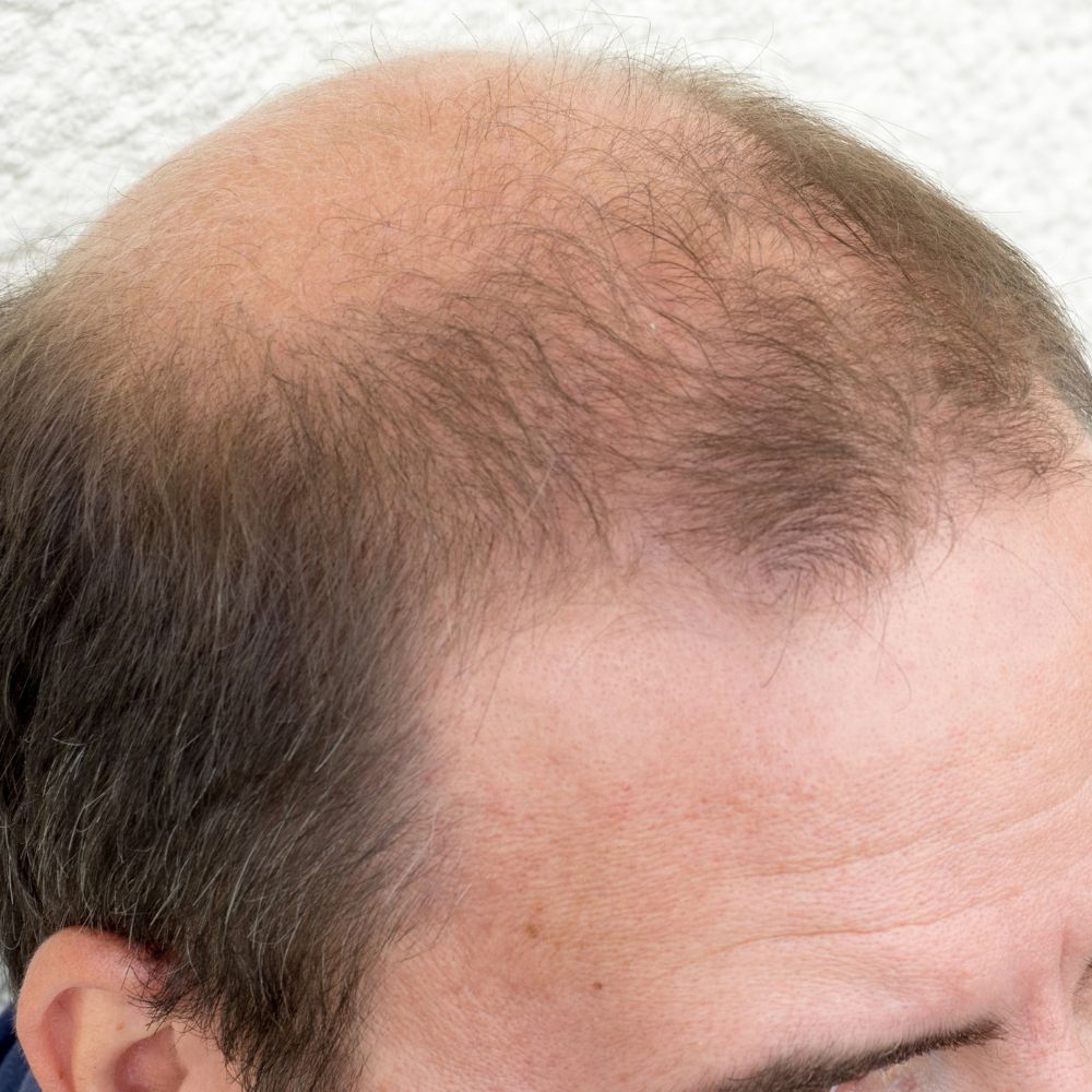 Khi các anh bước sang tuổi 40 thì mái tóc bắt đầu thưa, hói dần, đây không chỉ là vấn đề thẩm mỹ, mà còn ảnh hưởng trực tiếp đến sự tự tin trong công việc cũng như trong cuộc sống