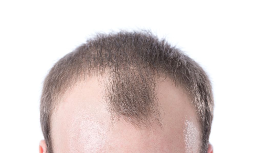 Tình trạng hói đầu ở nam giới (Male Pattern Baldness) chủ yếu đến từ bên trong cơ thể: di truyền và nội tiết tố