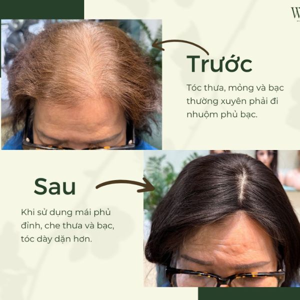 Rụng tóc, hói đầu – tưởng chừng chỉ là một vấn đề thẩm mỹ, nhưng lại có thể âm thầm làm xói mòn sự tự tin của rất nhiều người