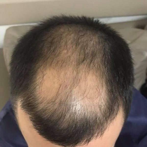 Những nguyên nhân rụng tóc ở nam giới