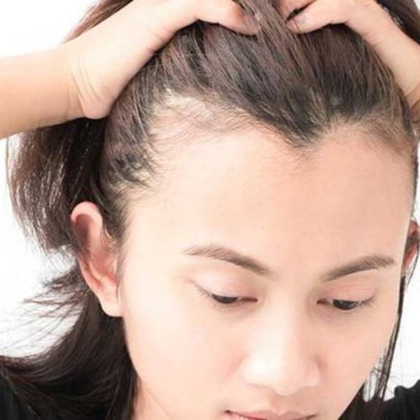 Những nguyên nhân rụng tóc nhiều ở nữ
