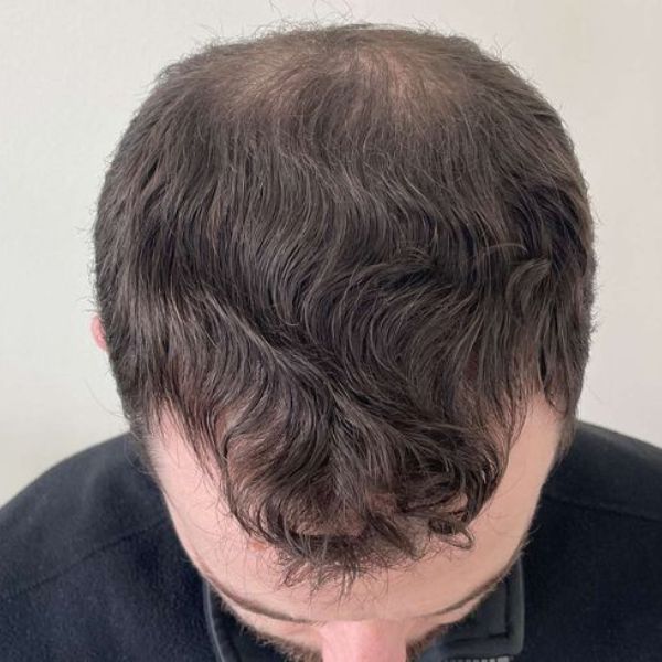 Nguyên nhân rụng tóc ở nam thường hay gặp phải