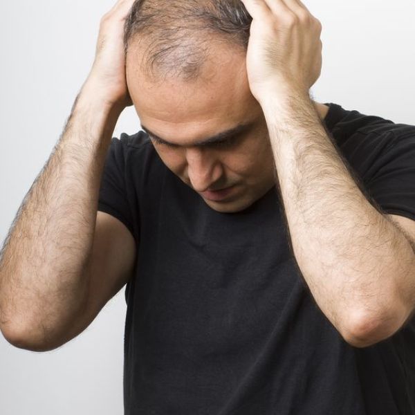 Nguyên nhân dẫn đến rụng tóc ở nam