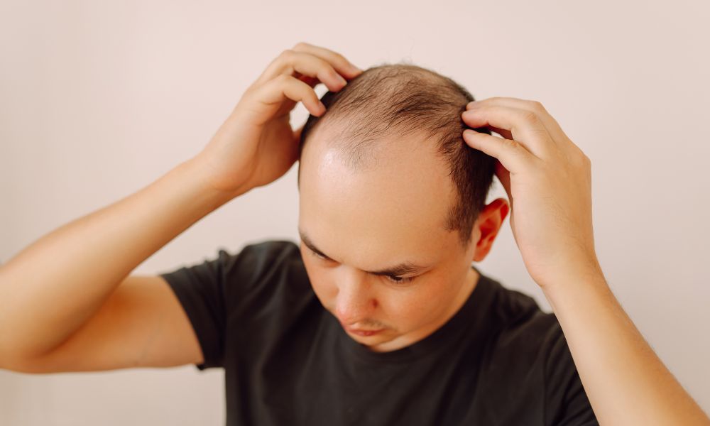 Dấu hiệu nhận biết hói đầu ở nam giới do DHT