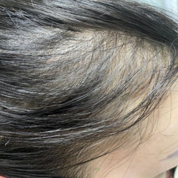 Thiếu dinh dưỡng cũng là nguyên nhân gây rụng tóc ở nữ nhiều