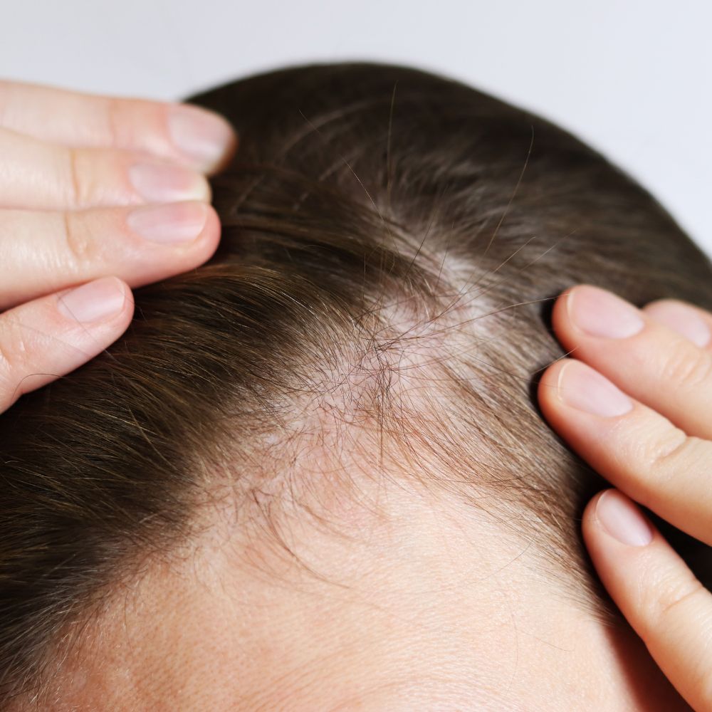 Bước vào giai đoạn tiền mãn kinh (thường từ 40-50 tuổi), nhiều phụ nữ phải đối diện với tình trạng rụng tóc không kiểm soát