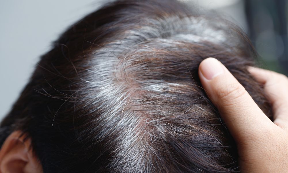 Stress, lo âu không chỉ ảnh hưởng đến tinh thần mà còn là kẻ thù của mái tóc