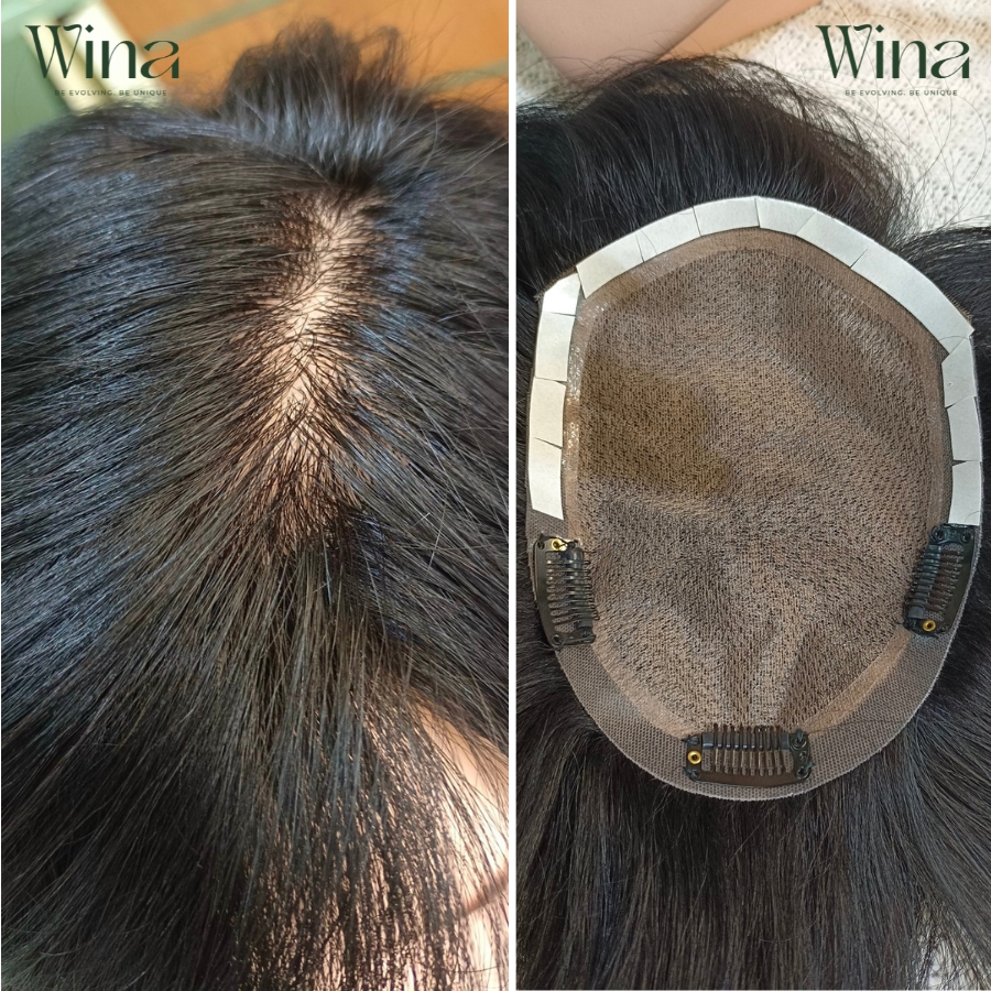 Tóc giả che hói đỉnh đầu cho nữ là giải pháp lý tưởng cho những người gặp tình trạng thưa hoặc rụng tóc ở phần đỉnh đầu và trán