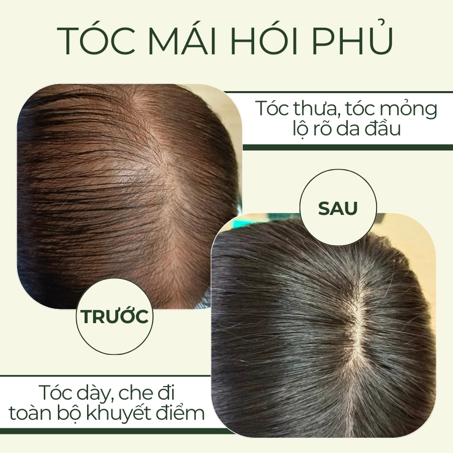 Tóc giả che hói đỉnh đầu nữ là giải pháp hoàn hảo cho những ai gặp tình trạng tóc mỏng hoặc rụng tóc từng mảng, đặc biệt là phụ nữ trung niên