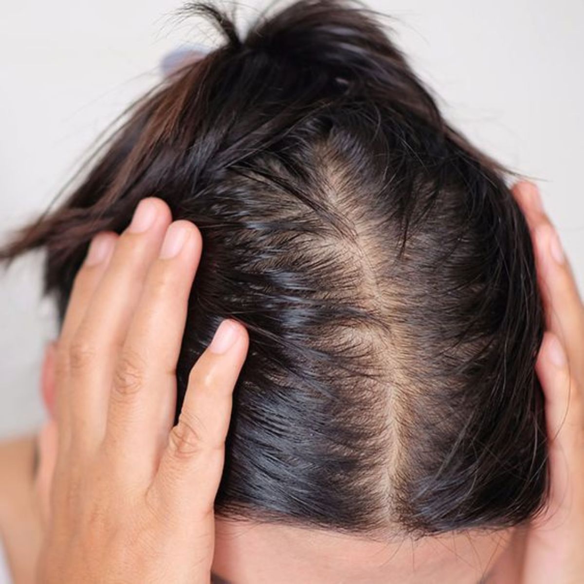 Tóc giả che hói nữ giải pháp cho tình trạng hói đầu