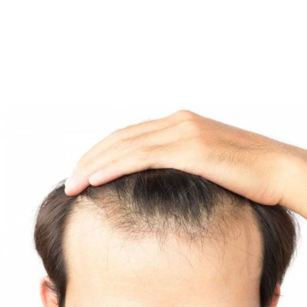 Tóc giả nam khắc phục tình trạng hói