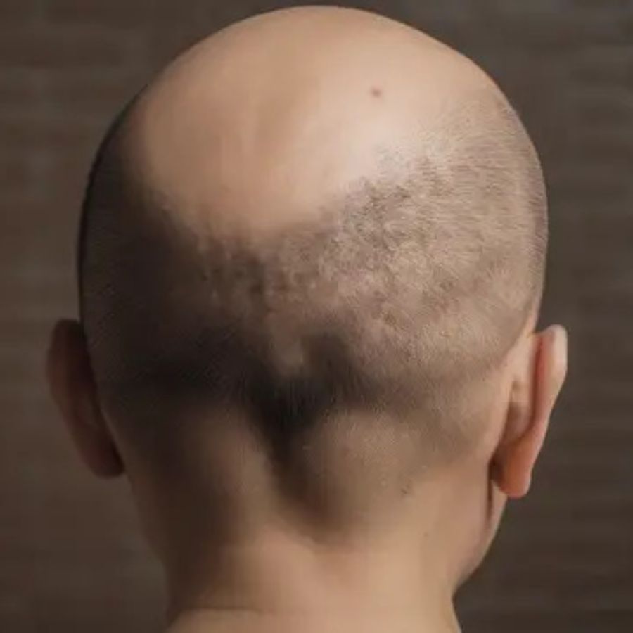 Hói tóc toàn bộ ở nam giới