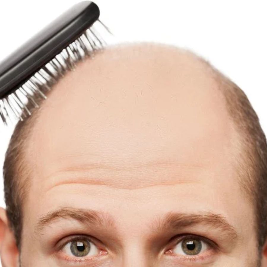Nam giới bị hói tóc