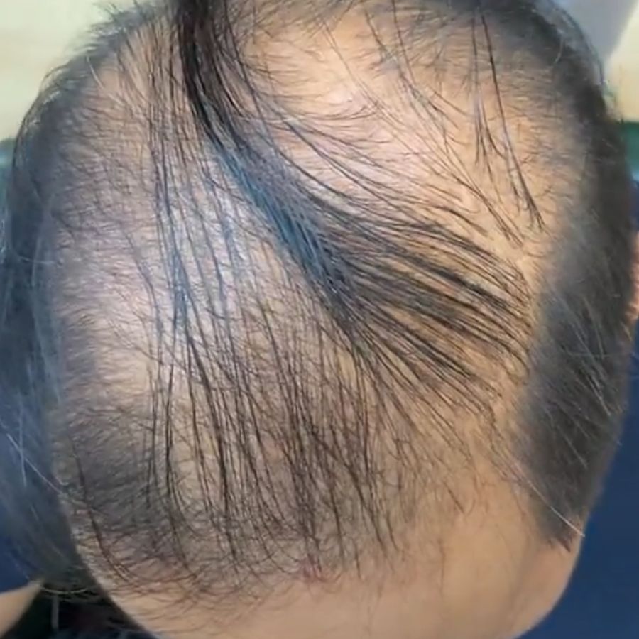 Nam giới bị hói tóc ở toàn đỉnh đầu