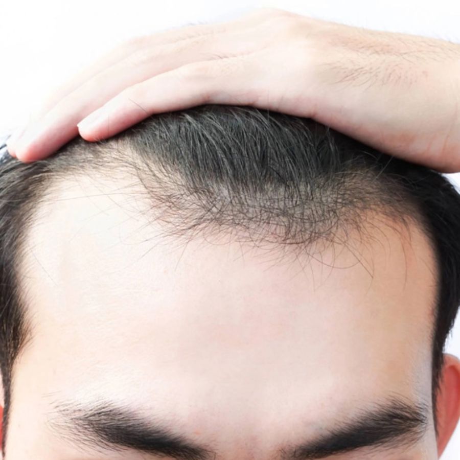 Nam giới bị rụng tóc ở phần trán và đỉnh đầu
