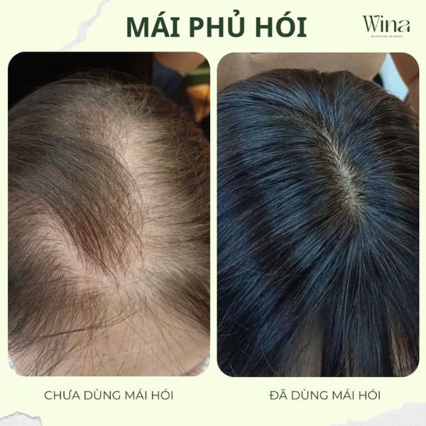Tóc giả không chỉ giúp che đi khuyết điểm một cách tự nhiên mà còn mang lại cảm giác thoải mái, giúp bạn tự tin hơn trong cuộc sống hàng ngày