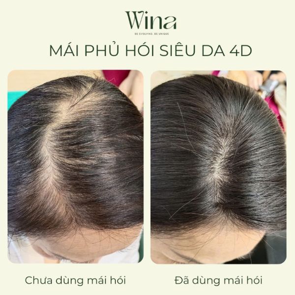 Lợi ích vượt trội của tóc giả