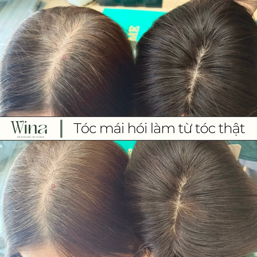 Mái hói che phủ khuyết điểm về tóc