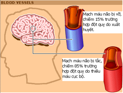 p118783 Ai dễ bị đột quỵ   Tai biến mạch máu não?