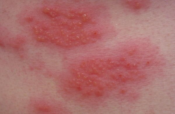 Chữa viêm da dị ứng ở trẻ em