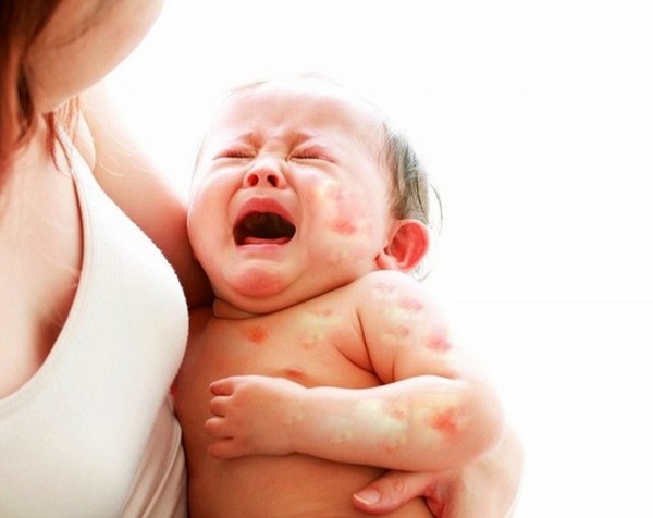 dị ứng ở trẻ em