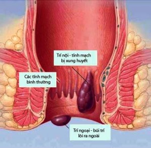 Tĩnh mạch bị phình giãn