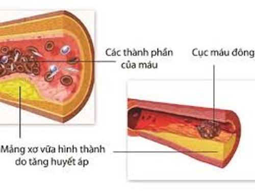 Biến chứng trên mạch máu của tăng huyết áp