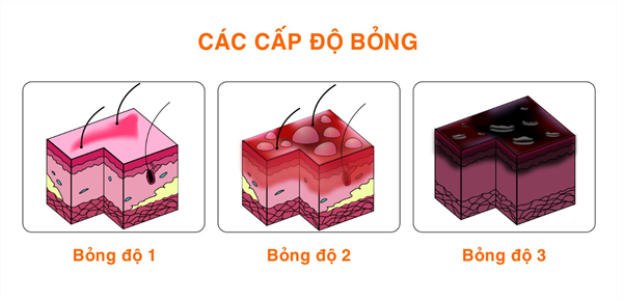 Các cấp đô bỏng