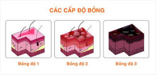 Các cấp độ bỏng