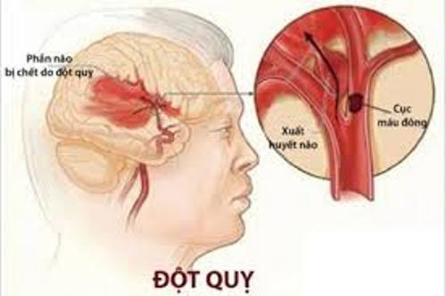 Biến chứng trên não của tăng huyết áp