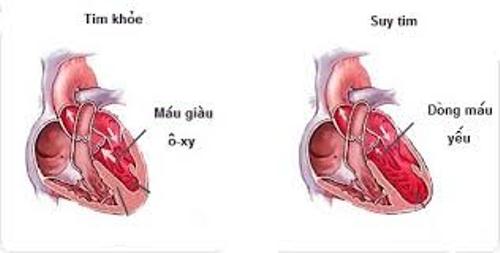 Biến chứng trên tim của tăng huyết áp