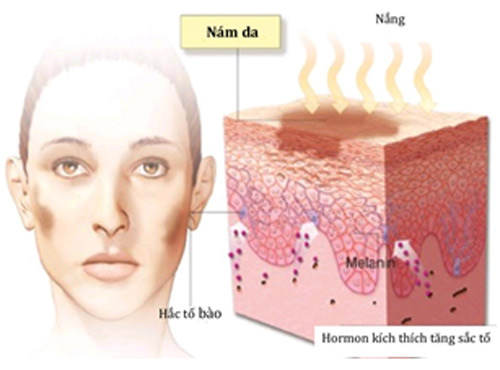 Tế bào sắc tố biểu bì