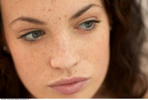 Sạm da, tàn nhang